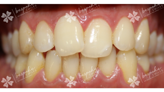 Occlusion 1 watermark