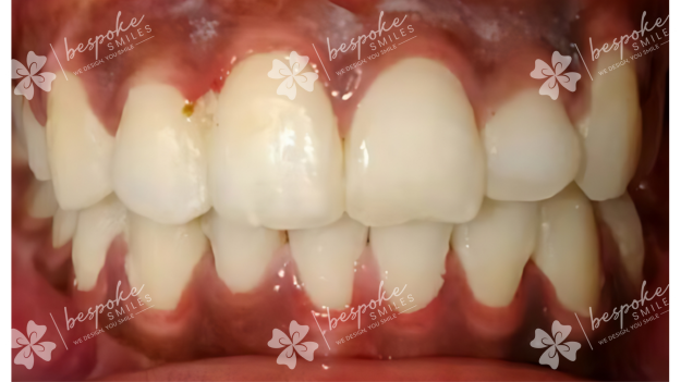 Occlusion 10 WM