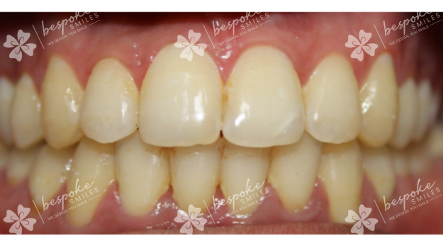 Occlusion 2 watermark