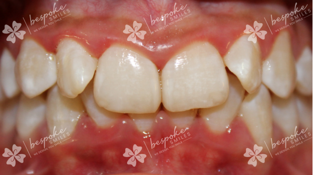 Occlusion 3 WM