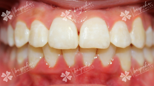 Occlusion 4 WM