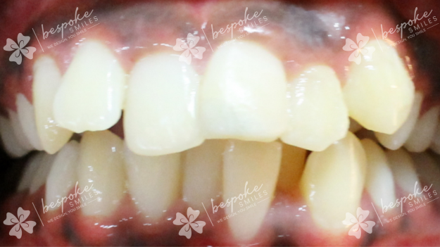 Occlusion 5 WM