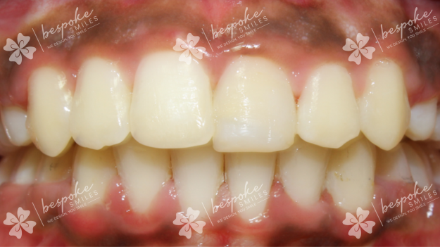 Occlusion 6 WM