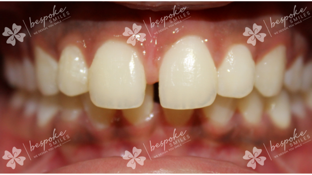 Occlusion 7 WM