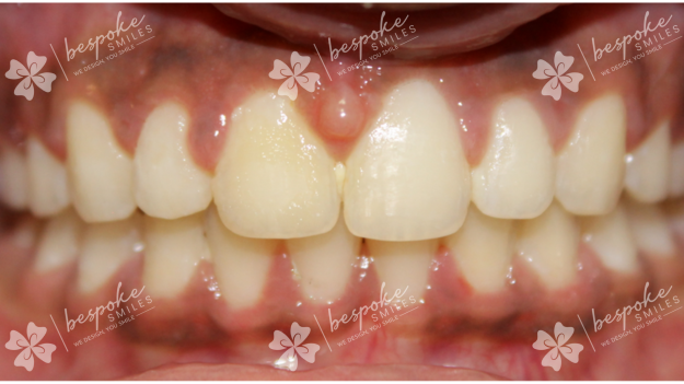 Occlusion 8 WM