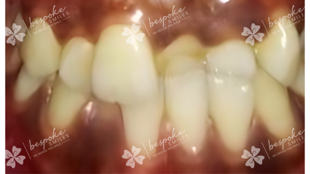 Occlusion 9 WM
