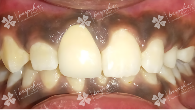 Restoration 14 WM